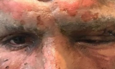 As&iacute; qued&oacute; el rostro de Lucas Viatri tras sufrir un accidente con pirotecnia
