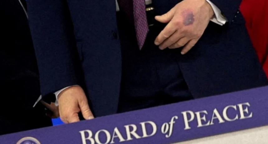 Ante nuevos rumores, Trump explic&oacute; por qu&eacute; tiene moretones en las manos