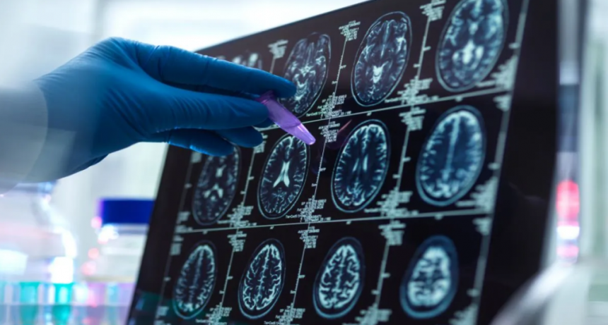 ACV: aumentan los casos en menores de 55 años y alertan sobre una epidemia silenciosa